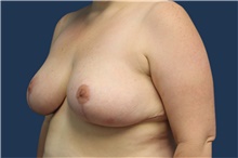 Breast Reduction After Photo by Laurence Glickman, MD, MSc, FRCS(c),  FACS; Garden City, NY - Case 41829