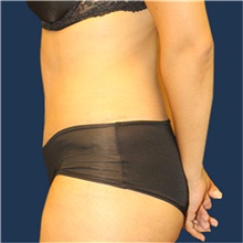 Tummy Tuck After Photo by Laurence Glickman, MD, MSc, FRCS(c),  FACS; Garden City, NY - Case 41830