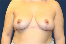 Breast Reduction After Photo by Laurence Glickman, MD, MSc, FRCS(c),  FACS; Garden City, NY - Case 41831