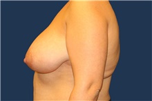 Breast Reduction Before Photo by Laurence Glickman, MD, MSc, FRCS(c),  FACS; Garden City, NY - Case 41831