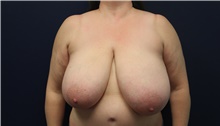 Breast Reduction Before Photo by Laurence Glickman, MD, MSc, FRCS(c),  FACS; Garden City, NY - Case 42507