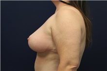 Breast Reduction After Photo by Laurence Glickman, MD, MSc, FRCS(c),  FACS; Garden City, NY - Case 42507