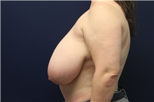 Breast Reduction Before Photo by Laurence Glickman, MD, MSc, FRCS(c),  FACS; Garden City, NY - Case 42507