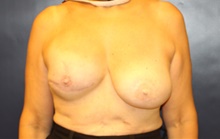 Breast Reconstruction Before Photo by Laurence Glickman, MD, MSc, FRCS(c),  FACS; Garden City, NY - Case 42508