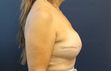 Breast Reconstruction After Photo by Laurence Glickman, MD, MSc, FRCS(c),  FACS; Garden City, NY - Case 42508