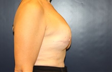 Breast Reconstruction Before Photo by Laurence Glickman, MD, MSc, FRCS(c),  FACS; Garden City, NY - Case 42508