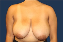 Breast Reduction Before Photo by Laurence Glickman, MD, MSc, FRCS(c),  FACS; Garden City, NY - Case 42509