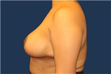 Breast Reduction After Photo by Laurence Glickman, MD, MSc, FRCS(c),  FACS; Garden City, NY - Case 42509