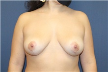 Breast Lift After Photo by Laurence Glickman, MD, MSc, FRCS(c),  FACS; Garden City, NY - Case 42510