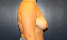 Breast Lift Before Photo by Laurence Glickman, MD, MSc, FRCS(c),  FACS; Garden City, NY - Case 42510