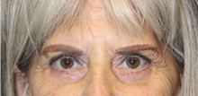 Eyelid Surgery After Photo by Laurence Glickman, MD, MSc, FRCS(c),  FACS; Garden City, NY - Case 42511