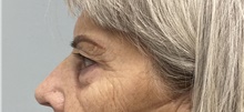 Eyelid Surgery Before Photo by Laurence Glickman, MD, MSc, FRCS(c),  FACS; Garden City, NY - Case 42511