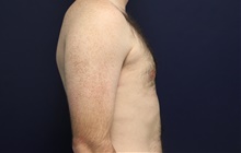 Male Breast Reduction After Photo by Laurence Glickman, MD, MSc, FRCS(c),  FACS; Garden City, NY - Case 42512