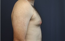 Male Breast Reduction Before Photo by Laurence Glickman, MD, MSc, FRCS(c),  FACS; Garden City, NY - Case 42512