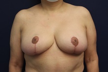 Breast Reduction After Photo by Laurence Glickman, MD, MSc, FRCS(c),  FACS; Garden City, NY - Case 43223