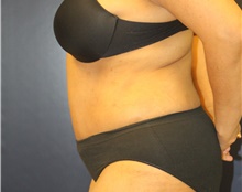 Tummy Tuck After Photo by Laurence Glickman, MD, MSc, FRCS(c),  FACS; Garden City, NY - Case 43224