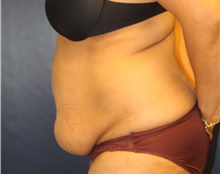 Tummy Tuck Before Photo by Laurence Glickman, MD, MSc, FRCS(c),  FACS; Garden City, NY - Case 43224