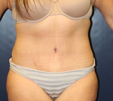 Tummy Tuck After Photo by Laurence Glickman, MD, MSc, FRCS(c),  FACS; Garden City, NY - Case 43225