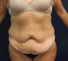 Tummy Tuck Before Photo by Laurence Glickman, MD, MSc, FRCS(c),  FACS; Garden City, NY - Case 43225