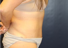 Tummy Tuck After Photo by Laurence Glickman, MD, MSc, FRCS(c),  FACS; Garden City, NY - Case 43225