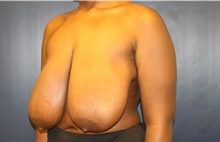 Breast Reduction Before Photo by Laurence Glickman, MD, MSc, FRCS(c),  FACS; Garden City, NY - Case 43227