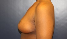 Breast Reduction After Photo by Laurence Glickman, MD, MSc, FRCS(c),  FACS; Garden City, NY - Case 43227