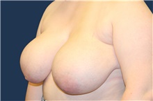 Breast Reduction Before Photo by Laurence Glickman, MD, MSc, FRCS(c),  FACS; Garden City, NY - Case 43228
