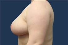 Breast Reduction After Photo by Laurence Glickman, MD, MSc, FRCS(c),  FACS; Garden City, NY - Case 43228