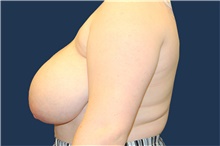 Breast Reduction Before Photo by Laurence Glickman, MD, MSc, FRCS(c),  FACS; Garden City, NY - Case 43228