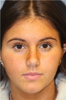 Rhinoplasty After Photo by Laurence Glickman, MD, MSc, FRCS(c),  FACS; Garden City, NY - Case 43232