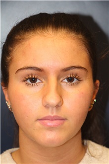 Rhinoplasty Before Photo by Laurence Glickman, MD, MSc, FRCS(c),  FACS; Garden City, NY - Case 43232