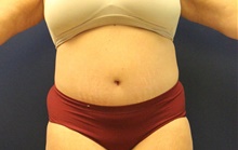 Tummy Tuck After Photo by Laurence Glickman, MD, MSc, FRCS(c),  FACS; Garden City, NY - Case 43233