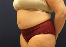 Tummy Tuck After Photo by Laurence Glickman, MD, MSc, FRCS(c),  FACS; Garden City, NY - Case 43233