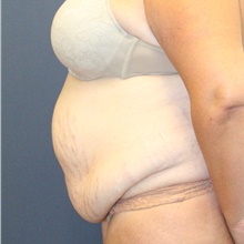 Tummy Tuck Before Photo by Laurence Glickman, MD, MSc, FRCS(c),  FACS; Garden City, NY - Case 43233