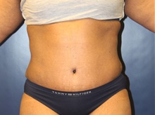 Tummy Tuck After Photo by Laurence Glickman, MD, MSc, FRCS(c),  FACS; Garden City, NY - Case 43234