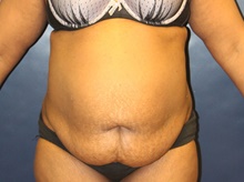 Tummy Tuck Before Photo by Laurence Glickman, MD, MSc, FRCS(c),  FACS; Garden City, NY - Case 43234