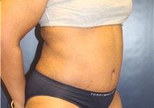 Tummy Tuck After Photo by Laurence Glickman, MD, MSc, FRCS(c),  FACS; Garden City, NY - Case 43234