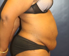 Tummy Tuck Before Photo by Laurence Glickman, MD, MSc, FRCS(c),  FACS; Garden City, NY - Case 43234