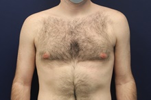 Male Breast Reduction After Photo by Laurence Glickman, MD, MSc, FRCS(c),  FACS; Garden City, NY - Case 43235