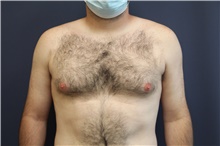 Male Breast Reduction Before Photo by Laurence Glickman, MD, MSc, FRCS(c),  FACS; Garden City, NY - Case 43235
