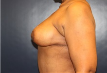 Breast Lift After Photo by Laurence Glickman, MD, MSc, FRCS(c),  FACS; Garden City, NY - Case 43236