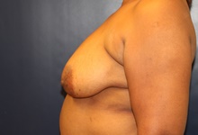 Breast Lift Before Photo by Laurence Glickman, MD, MSc, FRCS(c),  FACS; Garden City, NY - Case 43236
