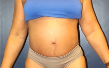 Tummy Tuck After Photo by Laurence Glickman, MD, MSc, FRCS(c),  FACS; Garden City, NY - Case 43239