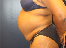 Tummy Tuck Before Photo by Laurence Glickman, MD, MSc, FRCS(c),  FACS; Garden City, NY - Case 43239