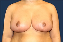 Breast Reduction After Photo by Laurence Glickman, MD, MSc, FRCS(c),  FACS; Garden City, NY - Case 43241