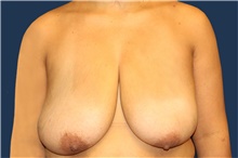 Breast Reduction Before Photo by Laurence Glickman, MD, MSc, FRCS(c),  FACS; Garden City, NY - Case 43241