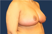 Breast Reduction After Photo by Laurence Glickman, MD, MSc, FRCS(c),  FACS; Garden City, NY - Case 43241