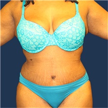 Tummy Tuck After Photo by Laurence Glickman, MD, MSc, FRCS(c),  FACS; Garden City, NY - Case 43243