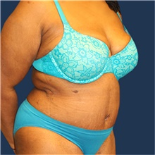 Tummy Tuck After Photo by Laurence Glickman, MD, MSc, FRCS(c),  FACS; Garden City, NY - Case 43243
