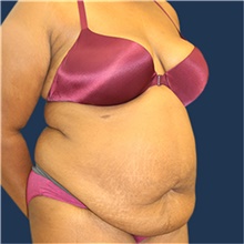 Tummy Tuck Before Photo by Laurence Glickman, MD, MSc, FRCS(c),  FACS; Garden City, NY - Case 43243